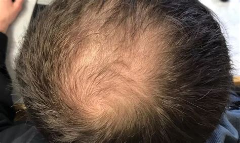 Combo Of Spironolactone And Minoxidil Effective Against Androgenetic