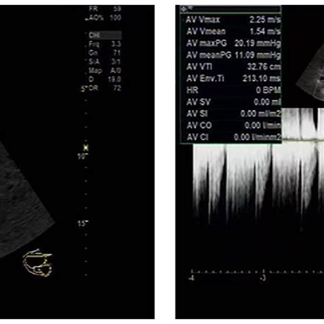 (Left panel) Echocardiography illustrating a bicuspid aortic valve with... | Download Scientific ...