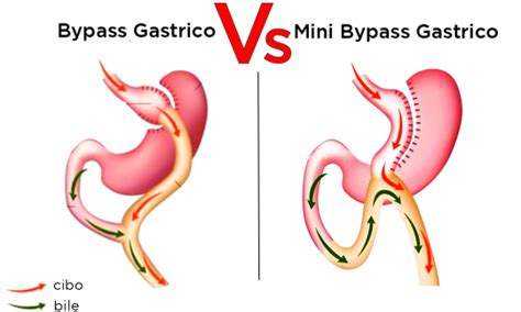 Bypass O Mini Bypass Quale Scegliere Dott Federico Messina