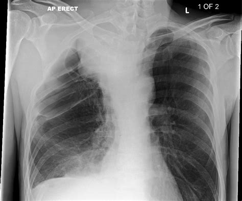 An Unusual Cause Of A Mediastinal Mass Bmj Case Reports