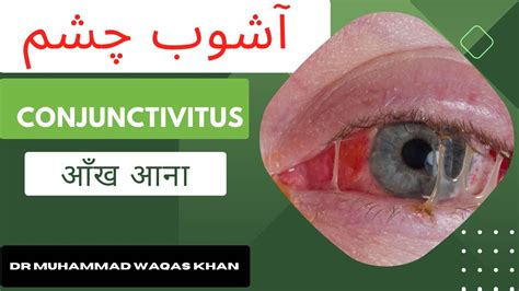 Pink Eye Cases On The Rise Viral Conjunctivitis In Urdu Hindi Youtube