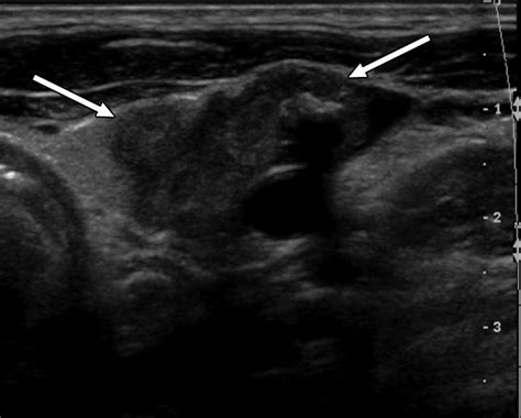 Medullary Carcinoma Thyroid Ultrasound