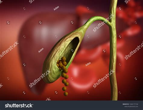 1332 Imágenes De Bile Duct Stones Imágenes Fotos Y Vectores De Stock Shutterstock