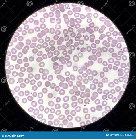 Abnormal Red Blood Cells In Blood Smear Thalassemia Patient Stock Photo