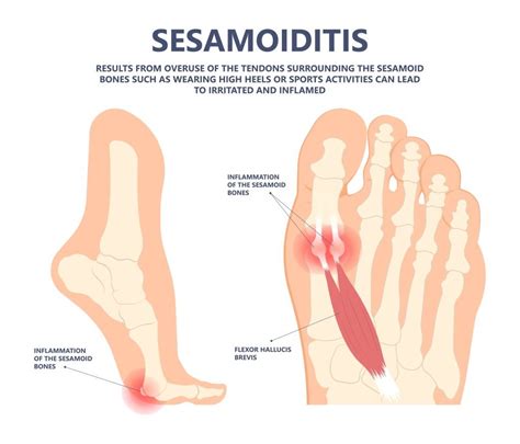 Sesamoid Problems - Physioflow PT | Physical Therapy | Vancouver, WA