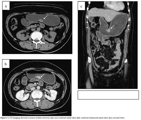 Gastric Ectopic Pancreas Manifested As A Subepithelial Tumor Three