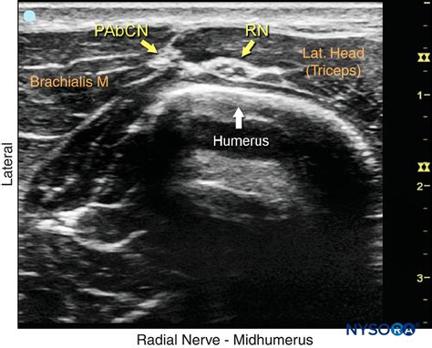 Ultrasound-Guided Blocks at the Elbow - NYSORA