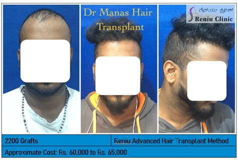 Best Hair Transplant In Mysore Reniu Clinic