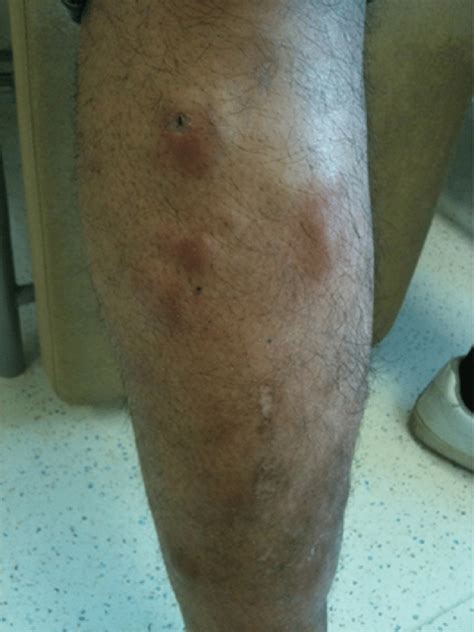 Maculopapular Nodular Erythematous Skin Lesions On The Right Leg There Download Scientific