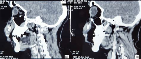 A Right And B Left Sagittal Slices Of Computed Tomography Scans Download Scientific Diagram