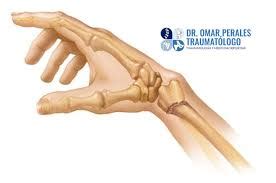 Fractura De Radio Distal Epidemiologia Sports Medicine Lima Dr