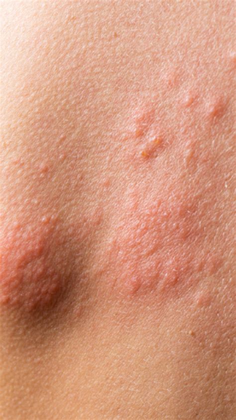 5 Early Signs Of Shingles You Should Not Ignore