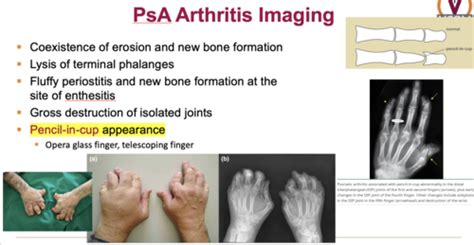 Immune Mediated Msk Disorders In Adults Ii Flashcards Quizlet