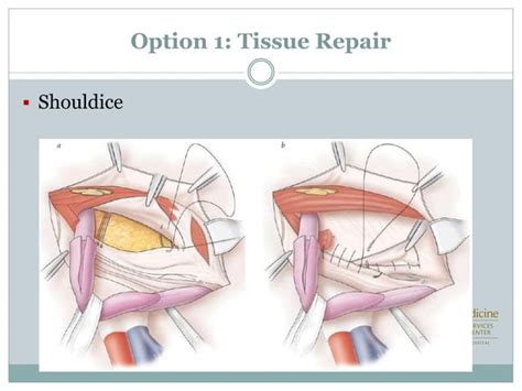 Laparoscopic Vs Open Inguinal Hernia Repair Ppt