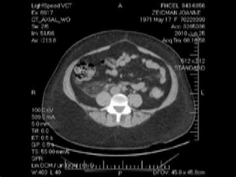 Ct Scan Images Of Kidney Stones / Health care professionals use imaging ...