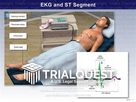 EKG and ST Segment - TrialQuest Inc.