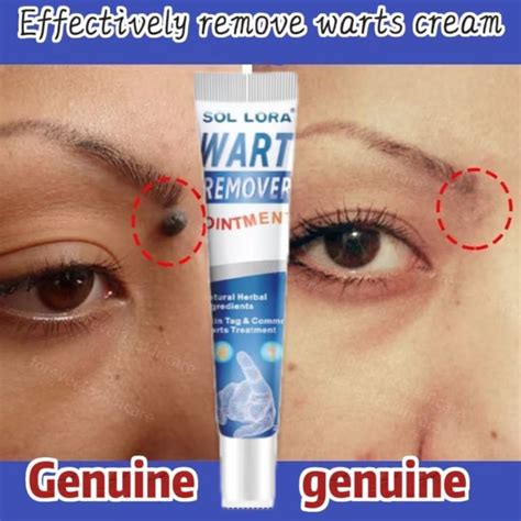 Warts Remover Cream 20g Wart Removal Ointment Neck Skin Tag Warts ...