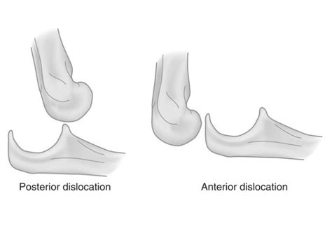 Elbow Dislocation