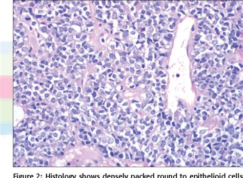 Figure 2 From Poorly Differentiated Monophasic Synovial Sarcoma Of The