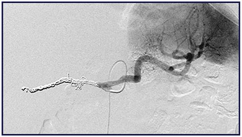 Targeted Versus Empiric Embolization For Delayed Postpancreatectomy