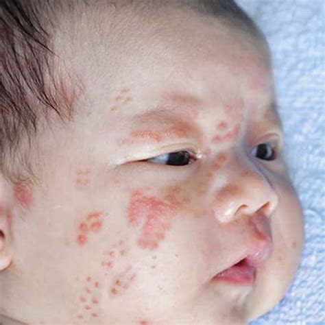 Neonatal Herpes Rash