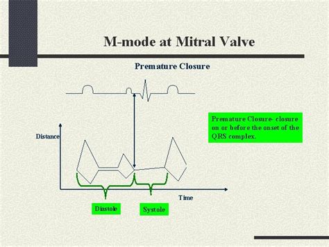 Mmode Echocardiogrphy The Lost Art Mmode Physics B