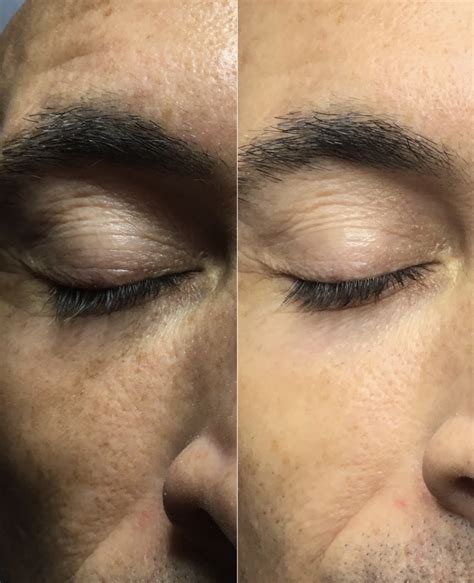 Co2 Laser Resurfacing And Patient Results Co2 Laser