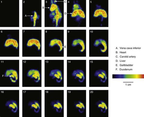 Single Photon Emission Computed Tomography Radiology Key