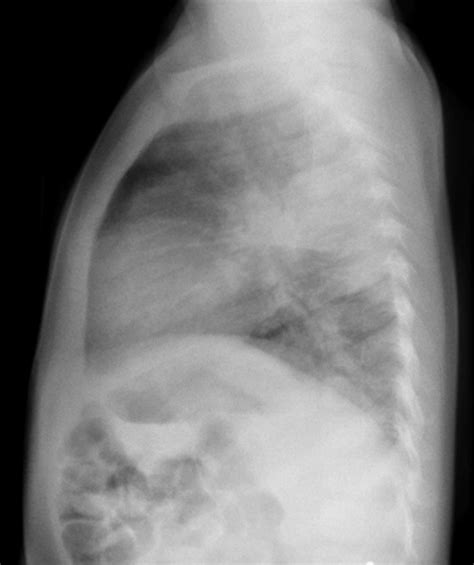 Pneumonia Undergraduate Diagnostic Imaging Fundamentals