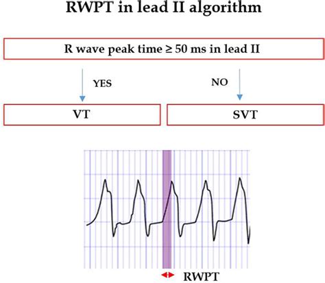 Electrocardiographic Differential Diagnosis Of Narrow QRS And Wide QRS