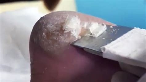 Safely Scrape Off Dead Skin On The Soles Of Feet 【foot Scalpel】 Youtube