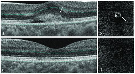 Oct And Octa Images Of Myopic Choroidal Neovascularization Mcnv In A