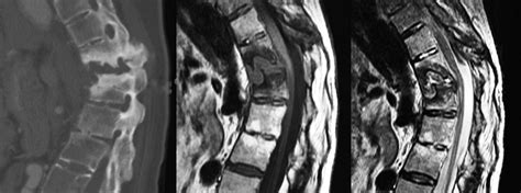 The Andersson Lesion In Ankylosing Spondylitis Bone And Joint