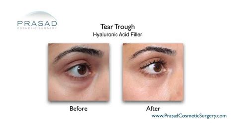 Effective Treatment Options For Bags Under The Eyes Dr Prasad Blog