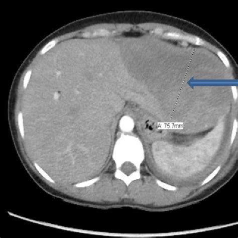 Deeply Inserted Endoscopic Retrograde Cholangiopancreatography ERCP