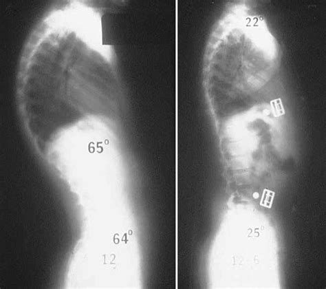 Kyphosis (Roundback) of the Spine - New Mexico Orthopaedic Associates