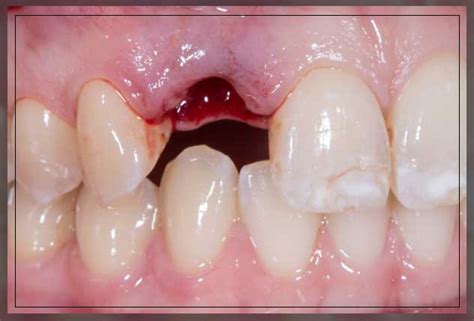 Avulsed Tooth Symptoms And Treatment Dentist Ahmed