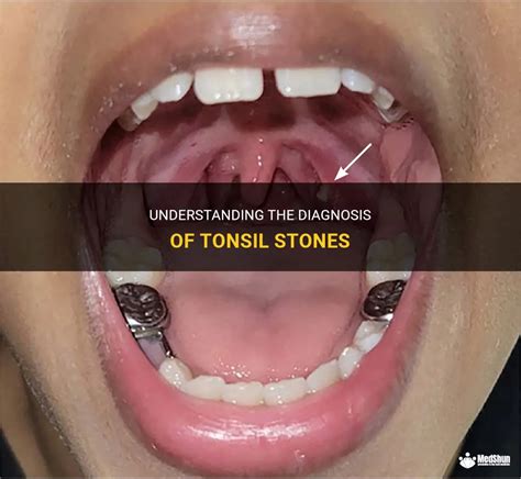 Understanding The Diagnosis Of Tonsil Stones Medshun