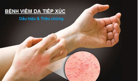 Viêm da tiếp xúc với xi măng DA LIỄU HỒNG ĐỨC