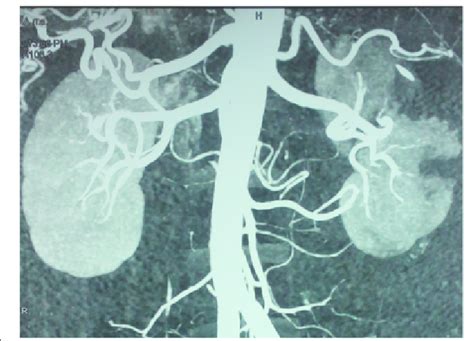 Computed Tomography Angiogram Of Abdomen Revealing Multiple Download Scientific Diagram