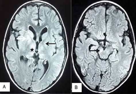 A. FLAIR image MRI brain (axial view) of patient showing... | Download ...