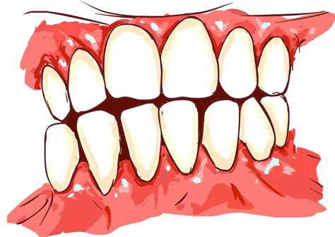 Signs of Gum Disease - Covington Dental