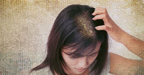 Can Dandruff Cause Hair Loss? What You Need To Know