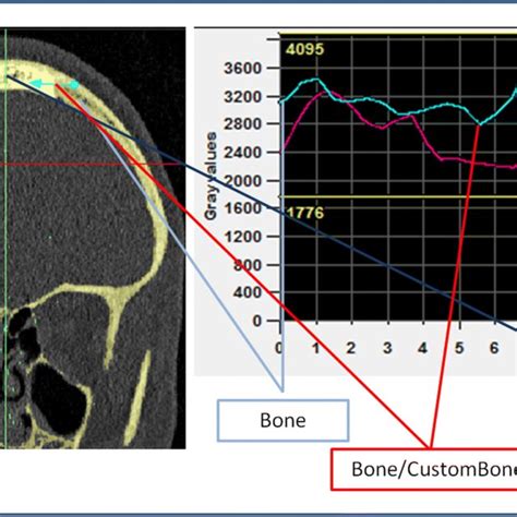 The Bone Density Was Measured According To The Hounsfield Unit Hu A Download Scientific