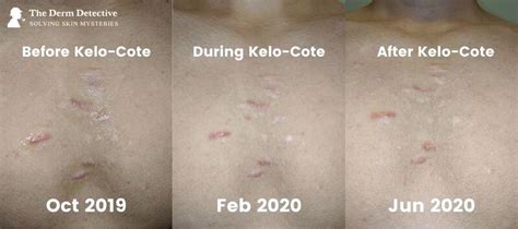 The 10 Best Scar Gels (With Before/After Pics) (2021 ) | The Derm Detective