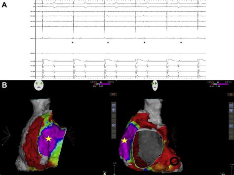 A The Intracardiac Electrograms Were Recorded During Coronary Sinus