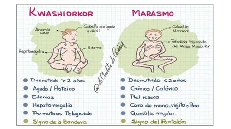 Diferencia Entre Marasmo Y Kwashiorkor Encuentra La Diferencia