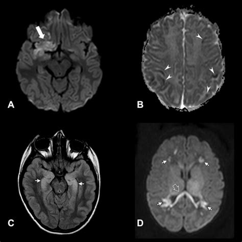 year  boy  herpes simplex virus encephalitis hsv