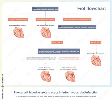 When Acute Inferior Myocardial Infarction Occurs The St Segment Offset