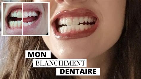 Blanchir Ses Dents Chez Le Dentiste Hot Sex Picture